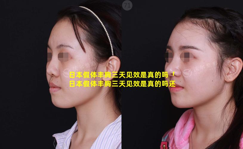 日本假体丰胸三天见效是真的吗「日本假体丰胸三天见效是真的吗还是假的 🌸 」